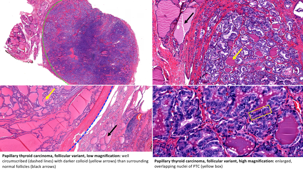 Variants of Papillary Thyroid Carcinoma (Microcarcinoma